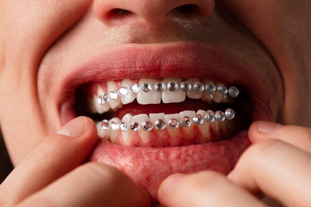 La moda delle gemme dentali